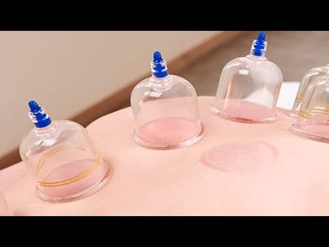 شاهد  الأمراض التي تعالجها الحجامة