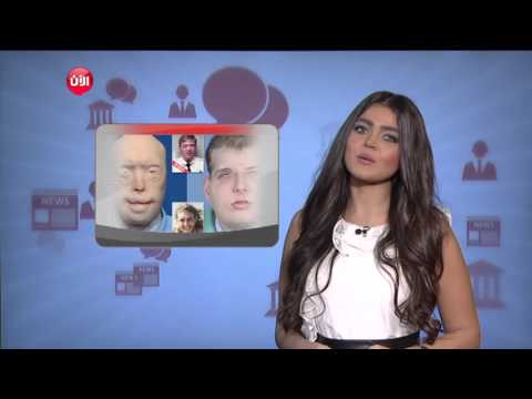 شاهد أنجح عملية زرع وجه والمتبرع شاب توفي في حادث