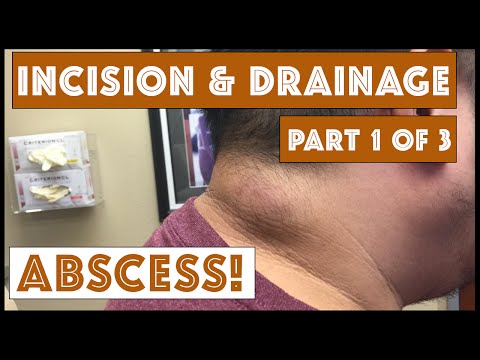 شاهدورم أسفل رأس رجل بحجم كرة الغولف