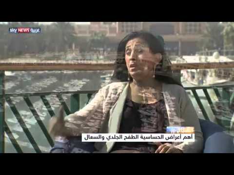 حساسية الغذاء الأكثر تطفلا على صحة الطفل