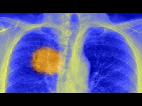 علماء يكتشفون كعب اخيل داخل الورم السرطاني للقضاء عليه