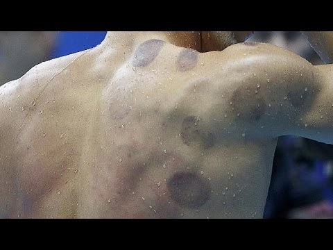 بالفيديو الحجامة تخطف الأضواء في أولمبياد البرازيل