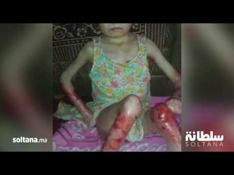 شاهد أسماء من تارودانت تعاني من مرض نادر يحول حياتها إلى جحيم