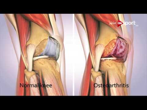 شاهد حالات خشونة الركبة وطرق علاجها