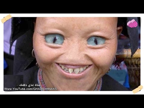 شاهد 10 أشخاص ولدوا بطفرات جينية صادمة