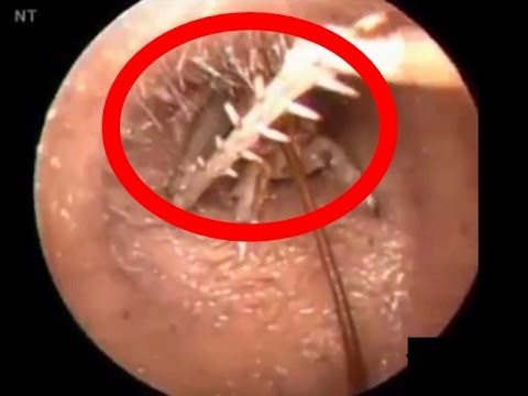 بالفيديو حشرات مرعبة تعيش في أذن الانسان