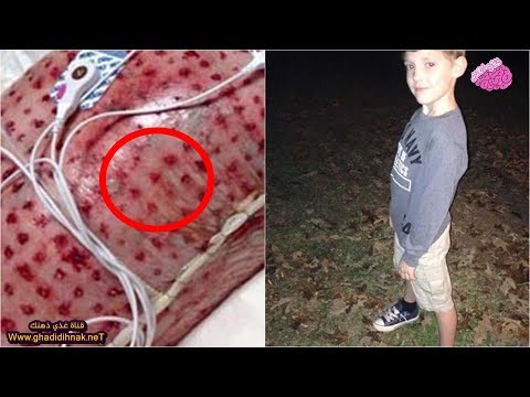 بالفيديو  ظن الأطباء أنه طفح جلدي وفوجئوا بالحقيقة