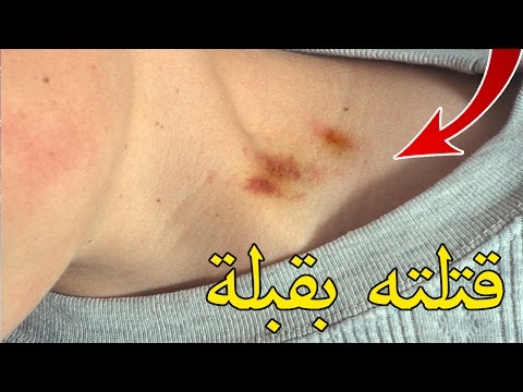 قبلة قوية على رقبة مراهق أدّت إلى مقتله