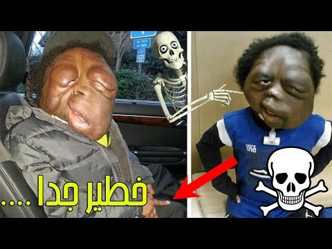 أماوري ستوفر طفل أميركي ملقّب بالوحش