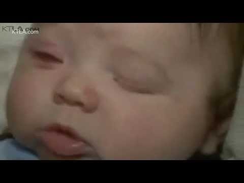 ولادة طفل من دون عينين في مستشفى بريطاني