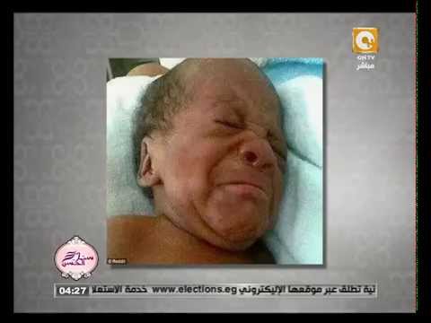 أطباء يرصدون صورًا لأطفال غاضبين بعد شهور من ولادتهم